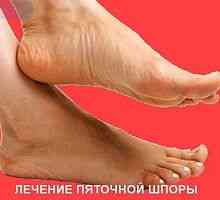 Tratamentul medicamentos al picioarelor calcaneale