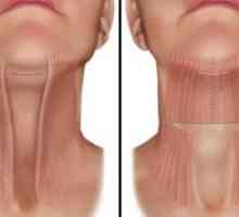 Metode de ridicare a gâtului și bărbii și caracteristicile acestora