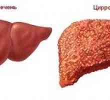 Este posibil să se vindece ciroza hepatică