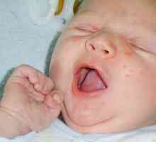 Cât de periculoasă este acneea pe fața unui nou-născut?