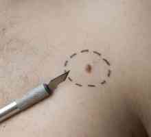 Neoplasme pe piele: fotografii, tipuri și metode de tratament