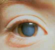 Cataractă complicată a ambilor ochi: ce este această patologie?