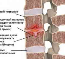 Caracteristicile herniei shmorlya și principiile tratamentului coloanei vertebrale