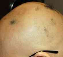 Caracteristici ale dezvoltării și tratamentului alopeciei totale la femei