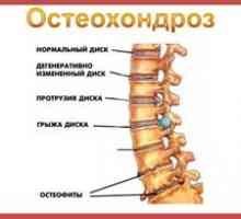 Osteocondroza coloanei vertebrale cervicale, simptome și tratament