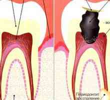 Parodontită acută: cauze, simptome și tratament