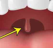 Umflarea palatinei în gât și de la care se poate mări