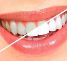 Plăci pentru albirea dinților: indicații și contraindicații