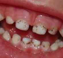 De ce apar puncte negre pe dinți și cum pot fi tratate?