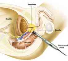 Pregătirea hipertiroidismului de prostată și modul de analiză