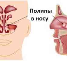 Polipisul nasului: simptome și tratament