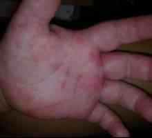 Cauze de mâncărime pete roșii pe mâini