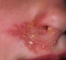Cauzele și tratamentul herpesului pe față