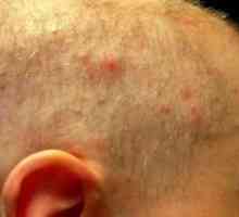 Cauzele și tratamentul acneei pe cap în părul bărbaților