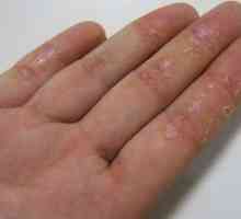 Cauzele eczemelor pe mâini și tratamentul acestora