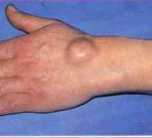 Cauzele de formare a unei bucăți sau a unui hygrom pe mâna