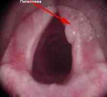 Cauzele apariției papilomilor în gât la copii și tratamentul acestora