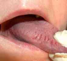Cauze de fisuri in limba, tratament