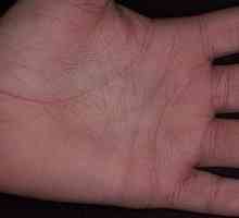 Cauzele mâncărime ale palmelor - de ce sunt mâinile mâncărime?