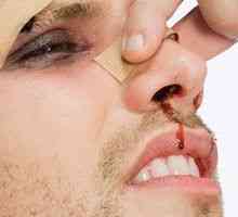 Semnele unui os nas rupt în persoana afectată