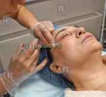 Procedura de plasmolifiere a feței în cosmetologie
