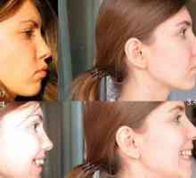 Ocluzia distală progenica: fotografii înainte și după bretele