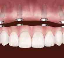 Proteza dinților pe implanturi: proteză detașabilă