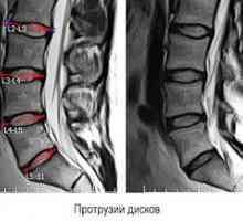 Protruzia coloanei vertebrale a coloanei vertebrale lombare: semne și simptome