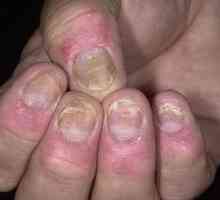 Psoriazisul unghiilor: simptome, cauze, tratament și fotografii