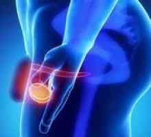 Cancerul testicular la bărbați: simptome și tratament