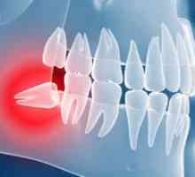 Retenția dintelui - ceea ce este, cauzele posibile și tratamentul