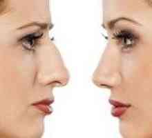 Rinoplastia: caracteristici ale chirurgiei plastice pe nas
