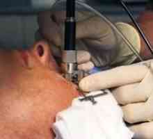 Chirurgia cea mai eficientă pentru ochi este metoda de lasik