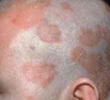 Dermatita dermatologică a scalpului: tratament și fotografii