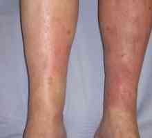 Simptomele și tratamentul dermatitei pe picioare, foto