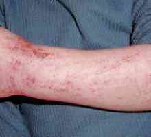 Simptomele și tratamentul dermatitei la adulți, foto