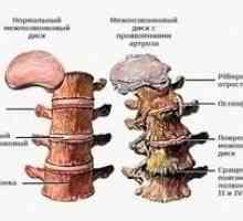 Simptomele și tratamentul osteocondrozei lombare a coloanei vertebrale