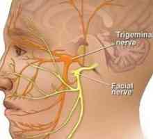 Simptomele și tratamentul inflamației nervului trigeminal