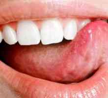 Simptomele și semnele de cancer ale limbii