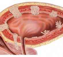 Simptome ale tumorii vezicii urinare la femei și bărbați