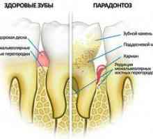 Simptomele bolii parodontale și modul de tratare a acesteia la domiciliu