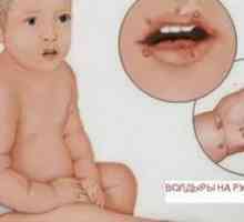 Simptomele virusului Coxsackie la copii și adulți