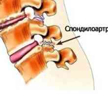 Spondiloza coloanei vertebrale lombosacrale: tratament