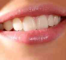 Metode de albire rapidă a dinților: recomandări și precauții