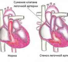 Stenoza arterei pulmonare la copiii nou-născuți