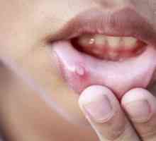 Stomatita intr-o gura: din cauza a ceea ce se intampla si cum sa tratezi
