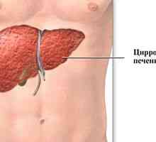 Distrugerea simptomelor de ciroză hepatică la femei