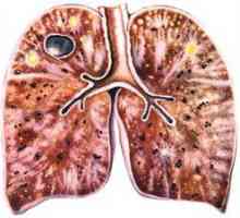 Tuberculoza: modul în care poate fi transmis, căile de transmisie și simptomele
