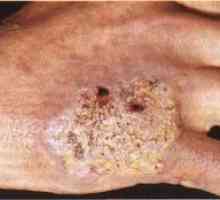 Tuberculoza pielii: tipuri, simptome, imagini vizuale
