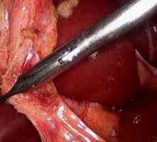 Îndepărtarea vezicii biliare: operații video laparoscopie